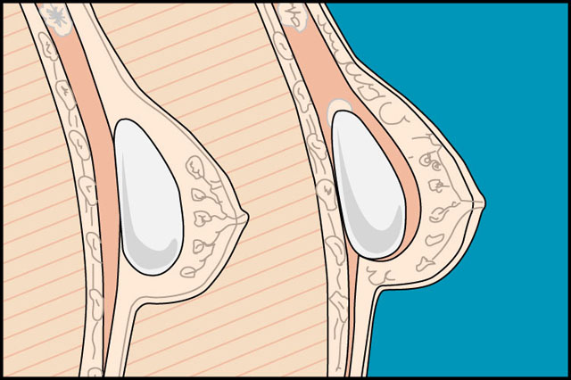 aumento_mamario_joaquin_nazar_anchorena_02