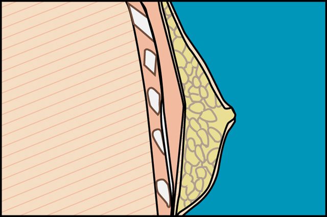 ginecomastia_joaquin_nazar_anchorena_01