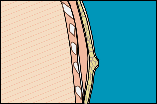 ginecomastia_joaquin_nazar_anchorena_02