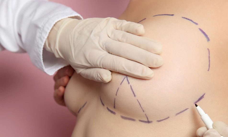 Lifting Mamario (Pexia)