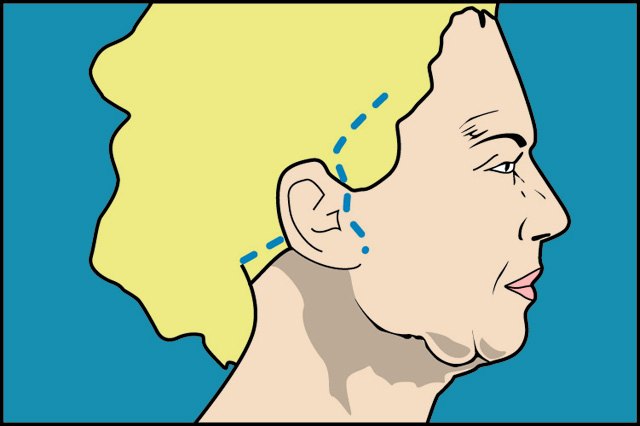 lifting_facial_joaquin_nazar_anchorena_02