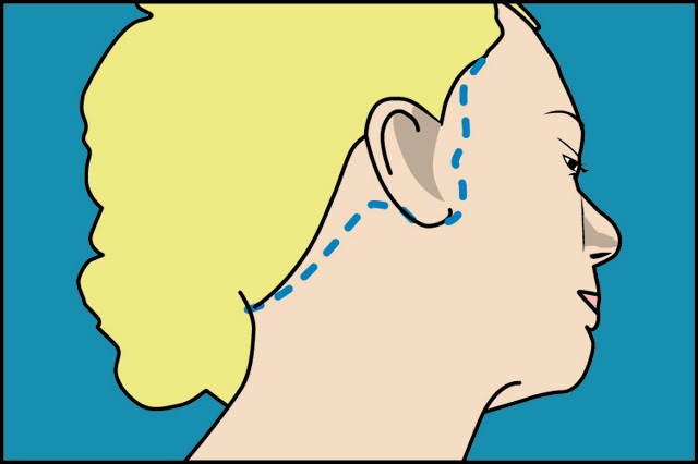 lifting_facial_joaquin_nazar_anchorena_03