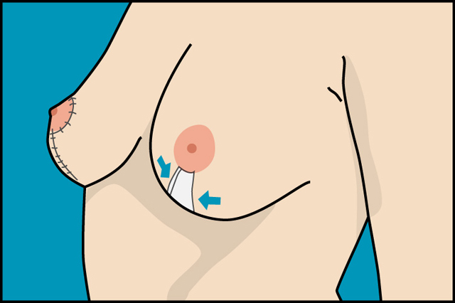 lifting_mamario_joaquin_nazar_anchorena_03