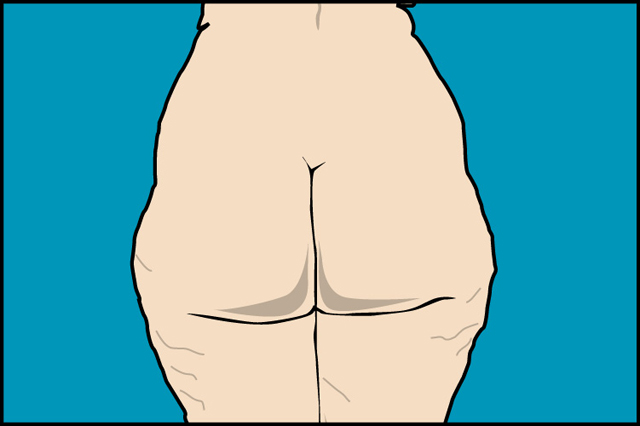 lipoaspiracion_joaquin_nazar_anchorena_01