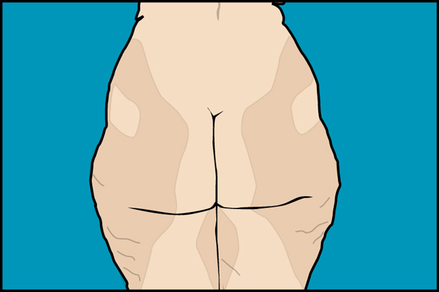 lipoaspiracion_joaquin_nazar_anchorena_02