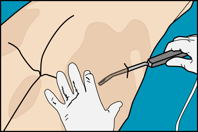 lipoaspiracion_joaquin_nazar_anchorena_03