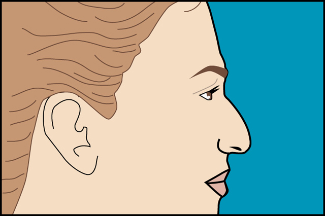 rinoplastia_joaquin_nazar_anchorena_01