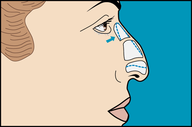 rinoplastia_joaquin_nazar_anchorena_02