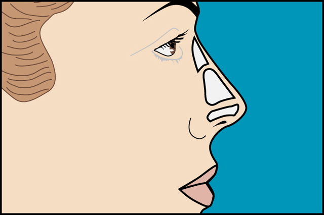 rinoplastia_joaquin_nazar_anchorena_03