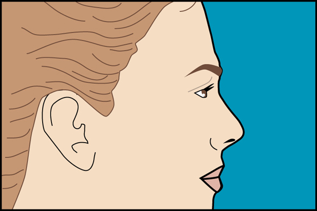 rinoplastia_joaquin_nazar_anchorena_04